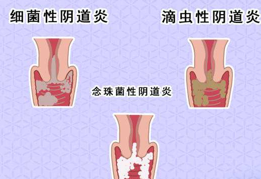 陰道分泌物中国X站XVDEVIOS安卓安装剖析什麽是細菌性陰道炎