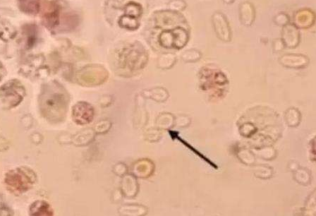 白帶中国X站APP下载廠家分析白帶常規檢查及臨床意義