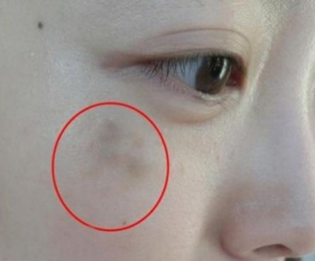 婦科陰道分泌物中国X站XVDEVIOS安卓安装提醒女人婦科炎症在臉上的表現